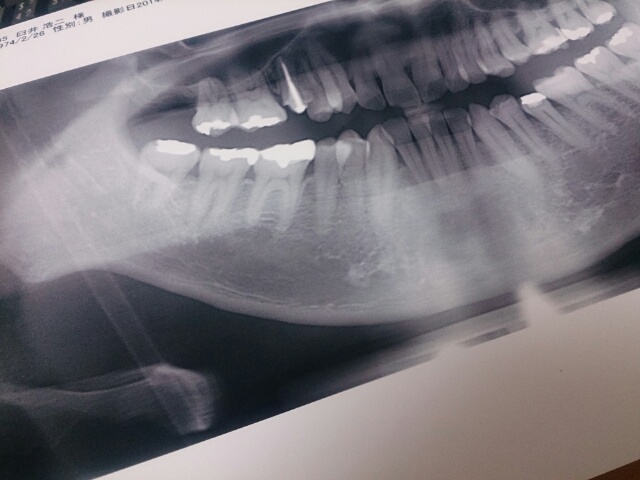 ぜんぜん関係ないけど、この間、歯医者さんで撮ってもらった写真